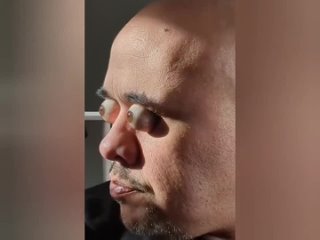 martin sanchez from uruguay knows how to roll out his eyes to 19 mm beyond the borders of the eye sockets.
